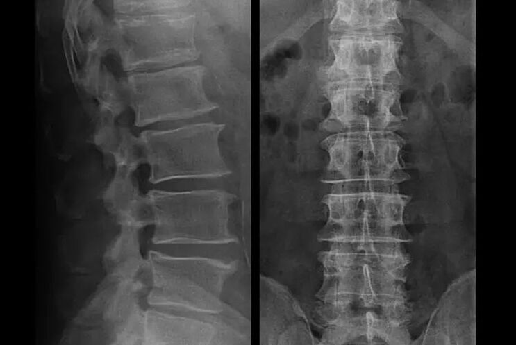 osteohondroza na rentgenskem slikanju