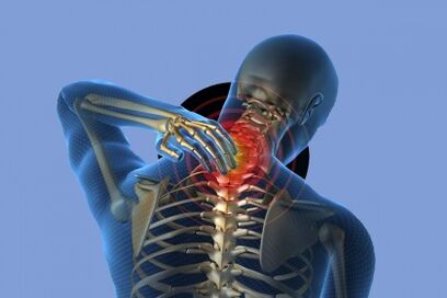 bolečina v vratu z osteohondrozo