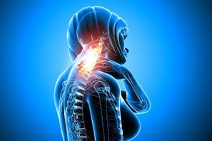 osteohondroza v vratni hrbtenici